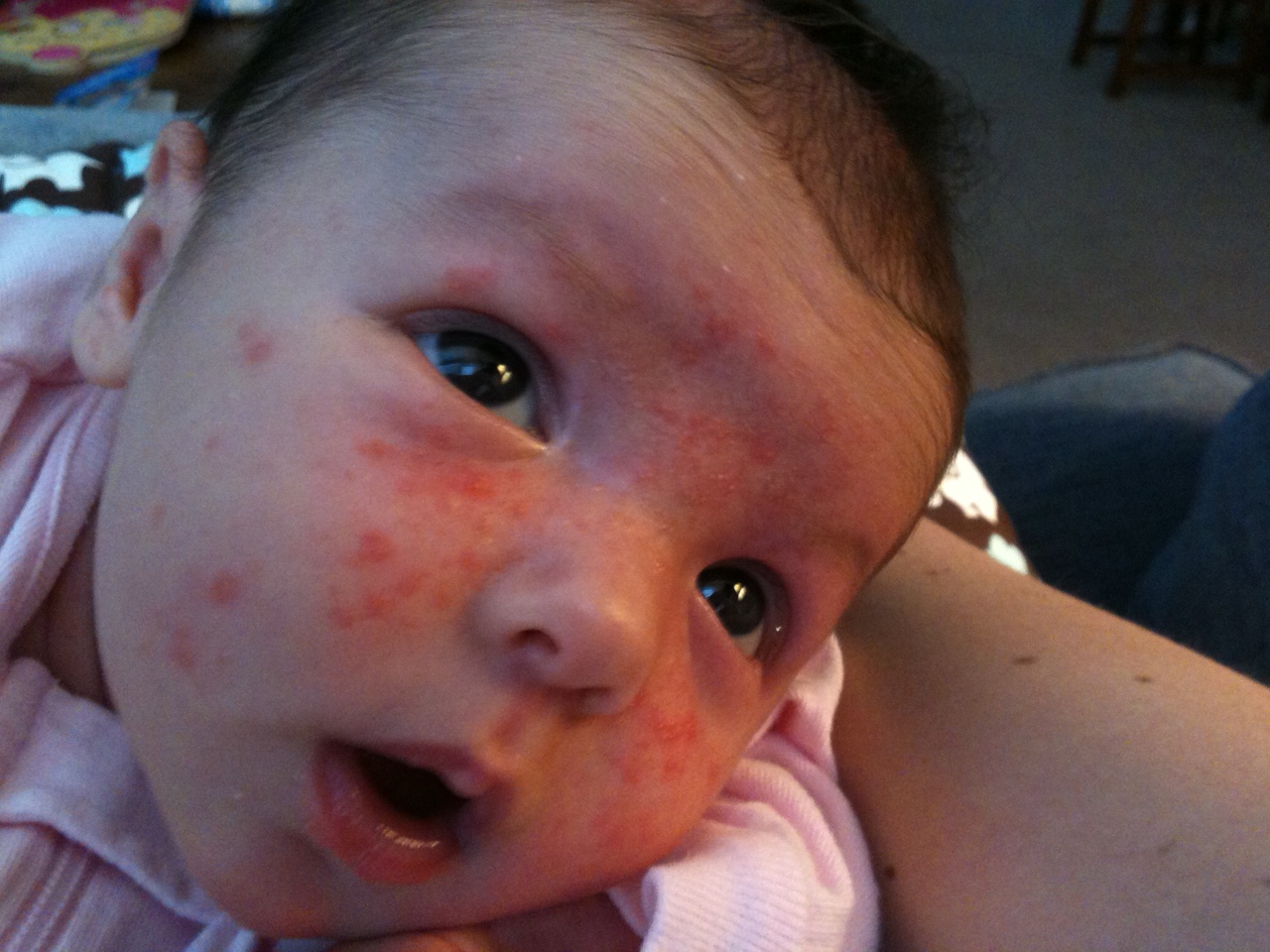 Baby Acne Pictures | MedicalPictures.net